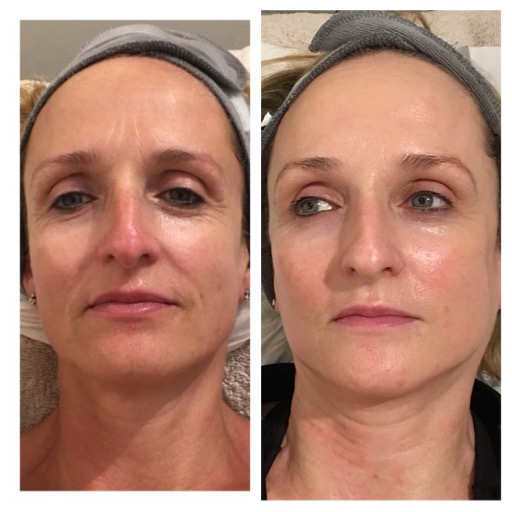 Before and After Image 1 - Environ, Skinpen, A-lift