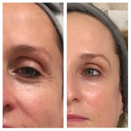 Before and After Image 2 - Environ, Skinpen, A-lift