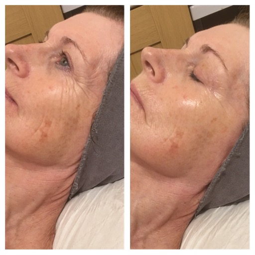 Before & After Image - Environ Collagen with A-Lift 