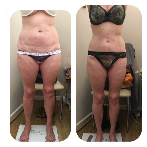 Lipofirm Body Before and After 1 Image