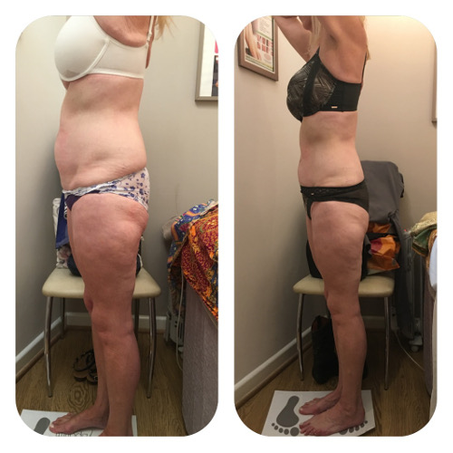 Lipofirm Body Before and After 2 Image