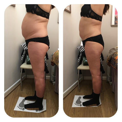 Lipofirm Body Before and After 3 Image