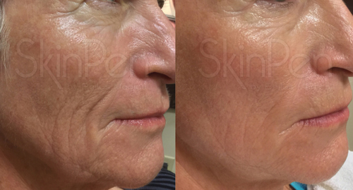 SkinPen Before and After