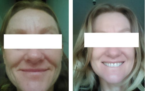 SkinPen before and after photos