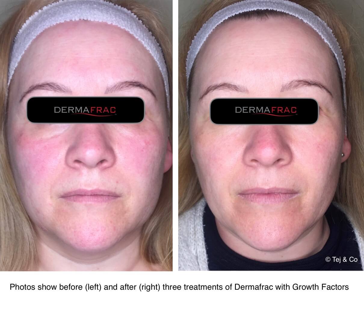 Dermafrac before and after